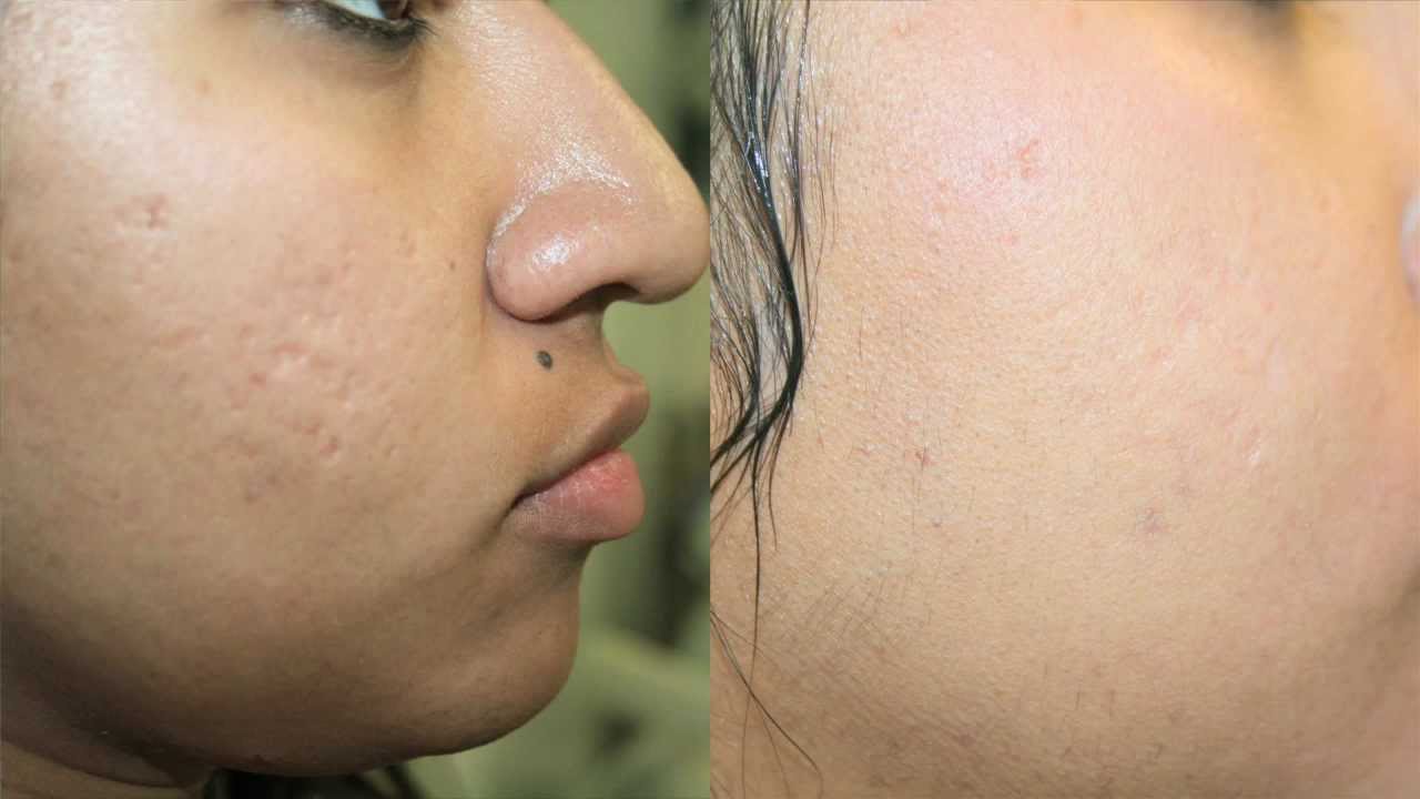 Different Acne Scar Removal Treatment