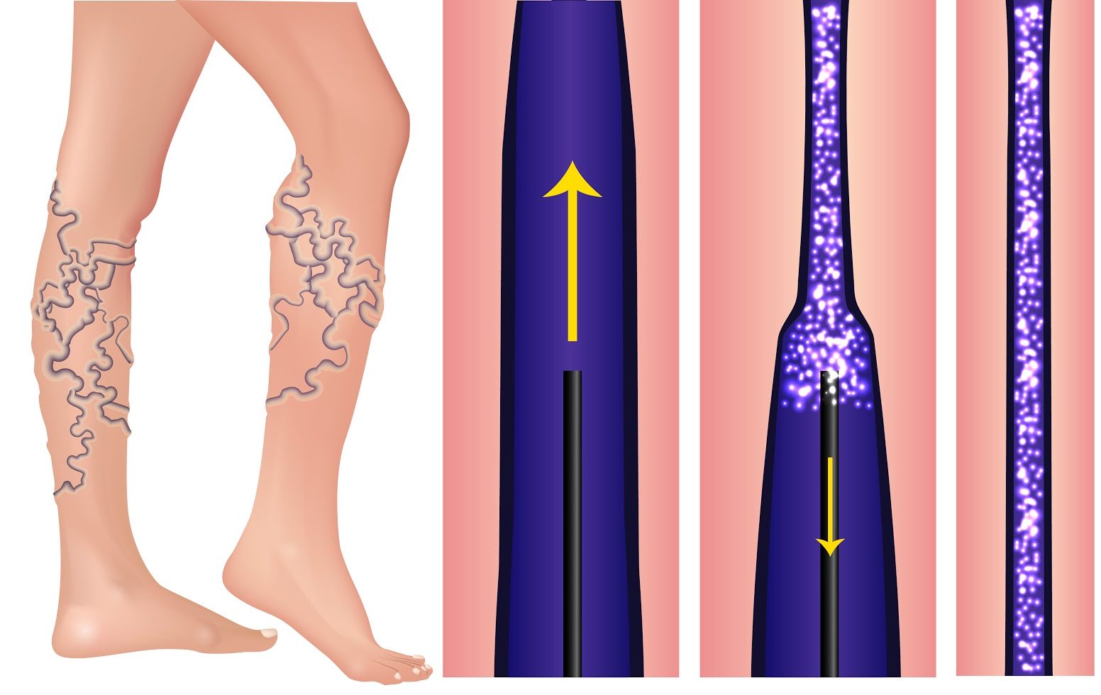 What Are the Best Leg Vein Treatments?